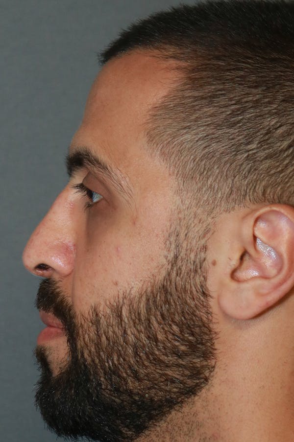 Aesthetic Rhinoplasty Before & After Gallery - Patient 48085876 - Image 4