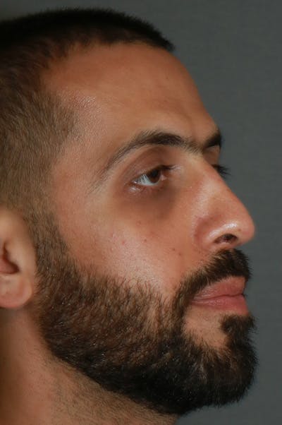 Aesthetic Rhinoplasty Before & After Gallery - Patient 48085876 - Image 6