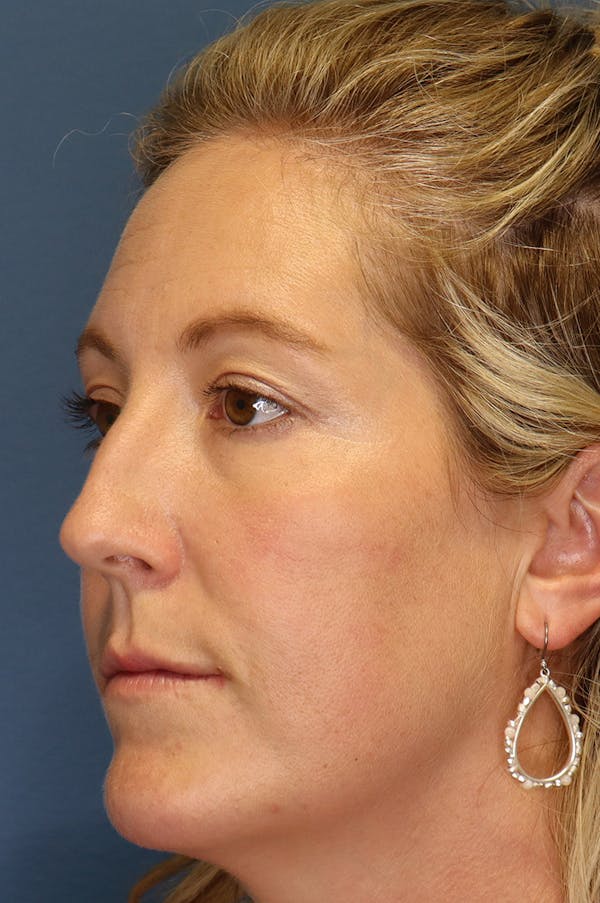 Aesthetic Rhinoplasty Before & After Gallery - Patient 48085877 - Image 1