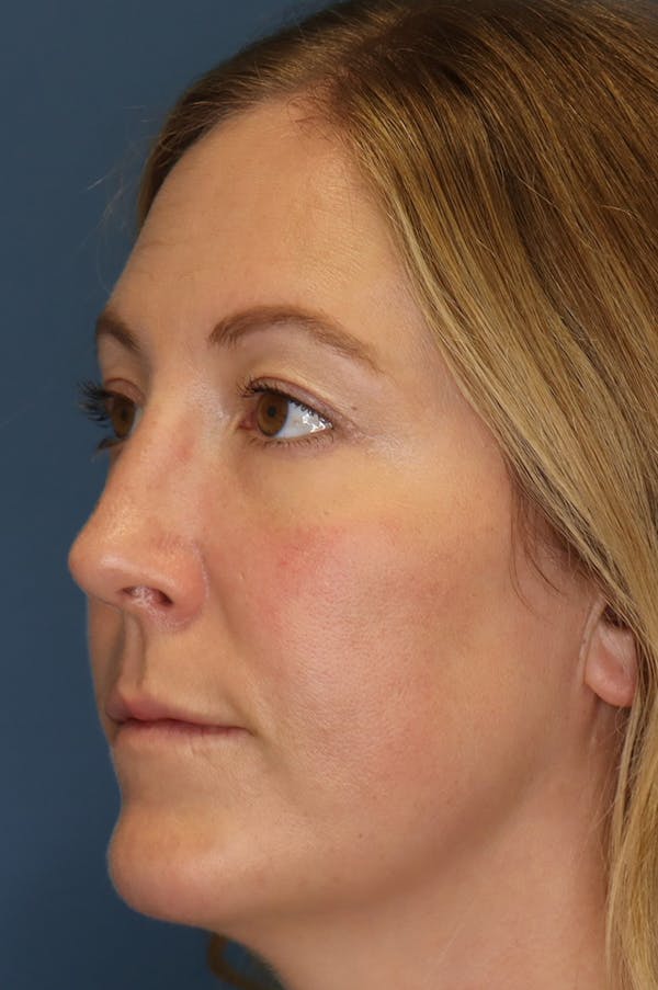 Aesthetic Rhinoplasty Before & After Gallery - Patient 48085877 - Image 2