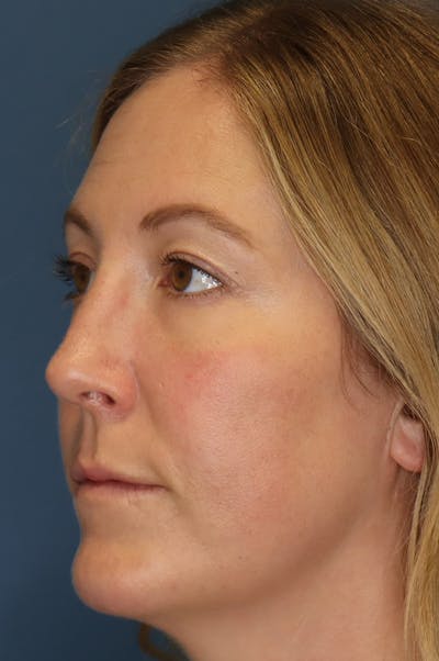 Aesthetic Rhinoplasty Before & After Gallery - Patient 48085877 - Image 2