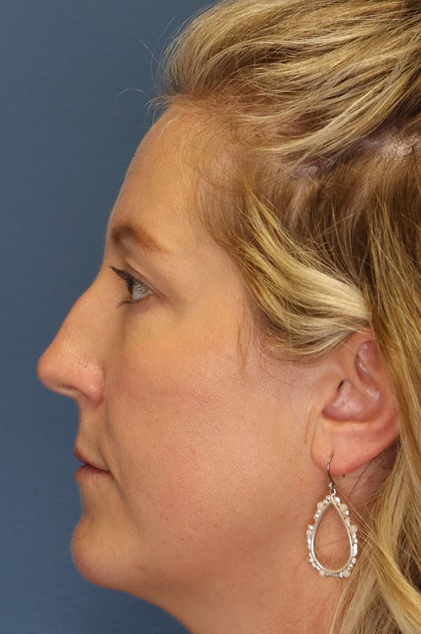 Aesthetic Rhinoplasty Before & After Gallery - Patient 48085877 - Image 3