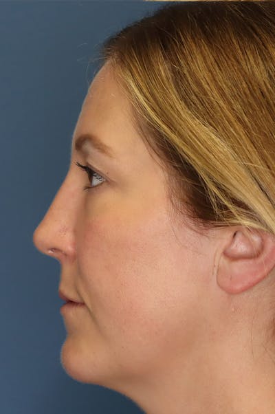 Aesthetic Rhinoplasty Before & After Gallery - Patient 48085877 - Image 4
