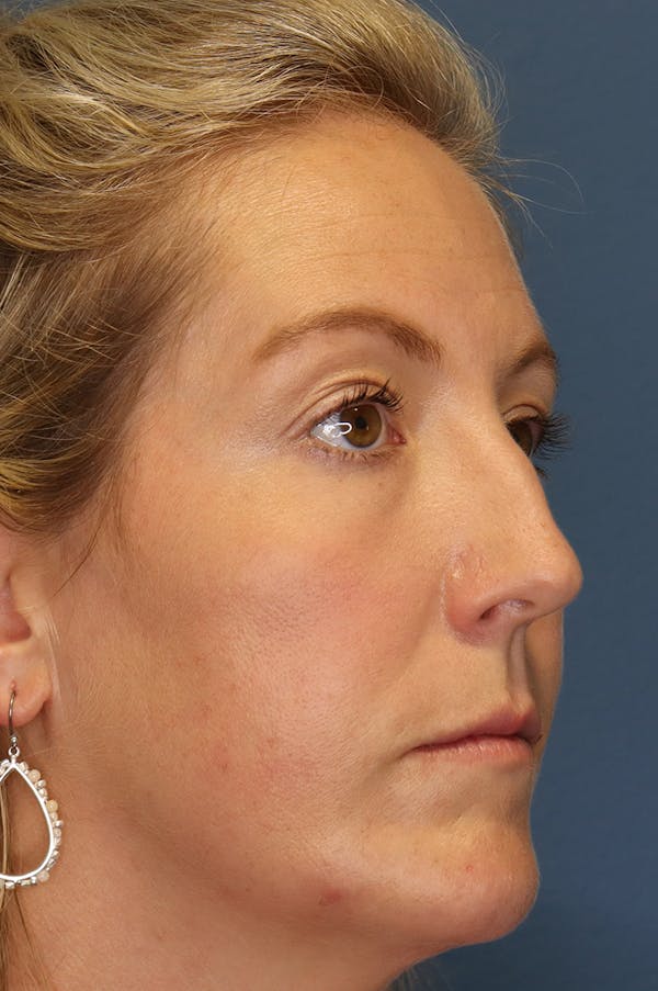 Aesthetic Rhinoplasty Before & After Gallery - Patient 48085877 - Image 5