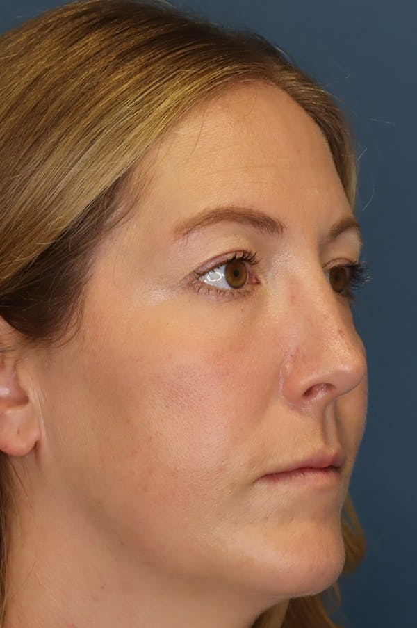 Aesthetic Rhinoplasty Before & After Gallery - Patient 48085877 - Image 6