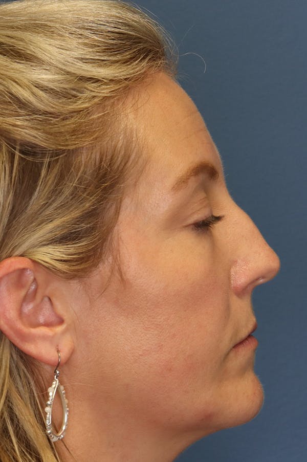 Aesthetic Rhinoplasty Before & After Gallery - Patient 48085877 - Image 7