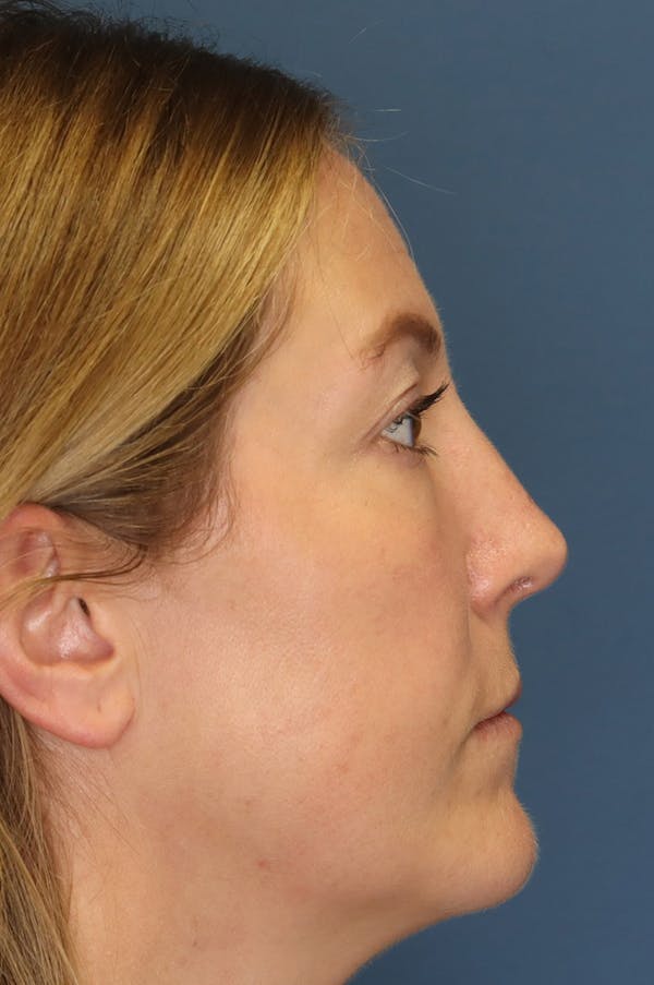 Aesthetic Rhinoplasty Before & After Gallery - Patient 48085877 - Image 8