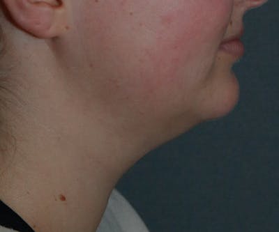 Double Chin (Submental Liposuction) Gallery - Patient 48939132 - Image 1