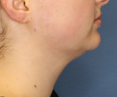 Double Chin (Submental Liposuction) Gallery - Patient 48939132 - Image 2