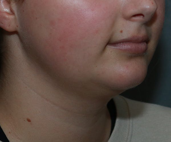 Double Chin (Submental Liposuction) Before & After Gallery - Patient 48939132 - Image 3