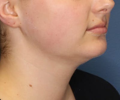 Double Chin (Submental Liposuction) Before & After Gallery - Patient 48939132 - Image 4
