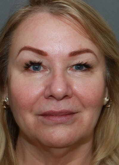 Facelift Before & After Gallery - Patient 63017706 - Image 1