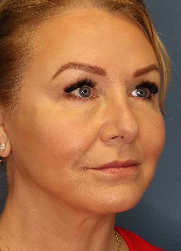 Facelift Before & After Gallery - Patient 63017706 - Image 5