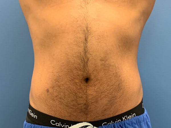 Cool Sculpting Before & After Gallery - Patient 51416736 - Image 1
