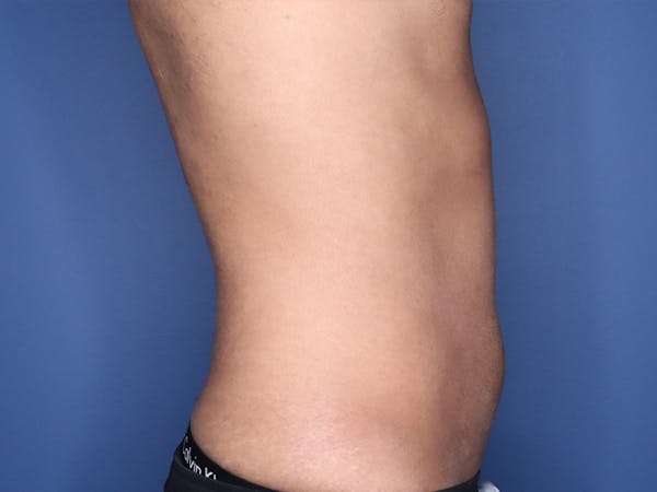 Cool Sculpting Before & After Gallery - Patient 51416736 - Image 6