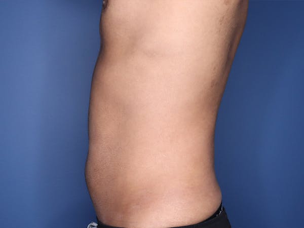 Cool Sculpting Before & After Gallery - Patient 51416736 - Image 8