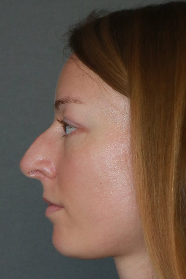 Aesthetic Rhinoplasty Before & After Gallery - Patient 53229901 - Image 3