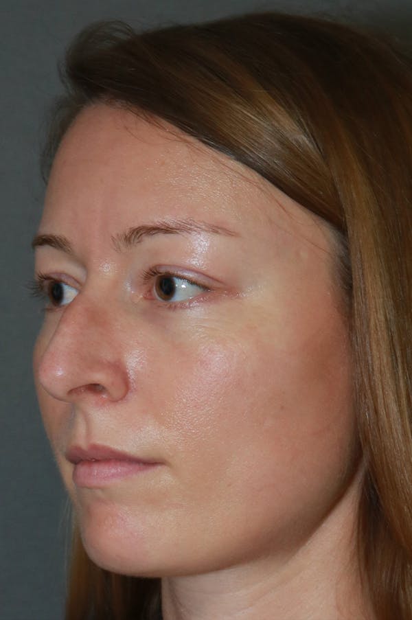 Aesthetic Rhinoplasty Before & After Gallery - Patient 53229901 - Image 1