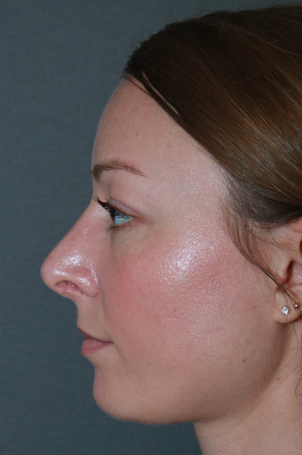 Aesthetic Rhinoplasty Before & After Gallery - Patient 53229901 - Image 4