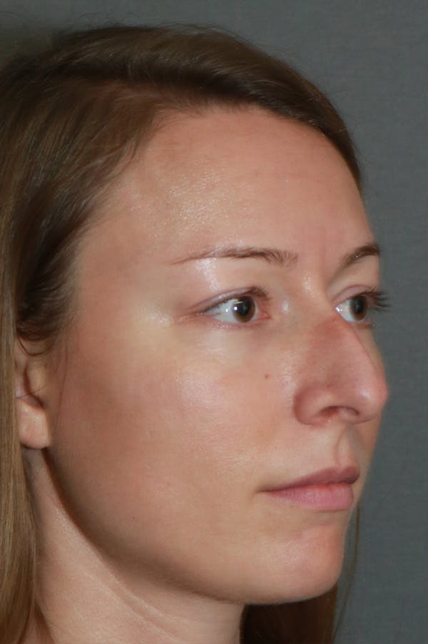 Aesthetic Rhinoplasty Before & After Gallery - Patient 53229901 - Image 5