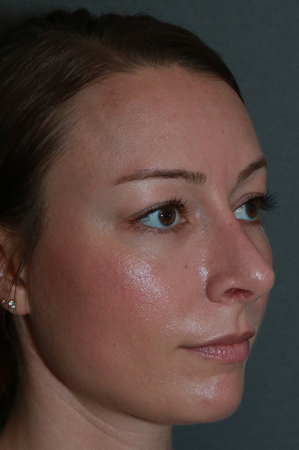 Aesthetic Rhinoplasty Before & After Gallery - Patient 53229901 - Image 6