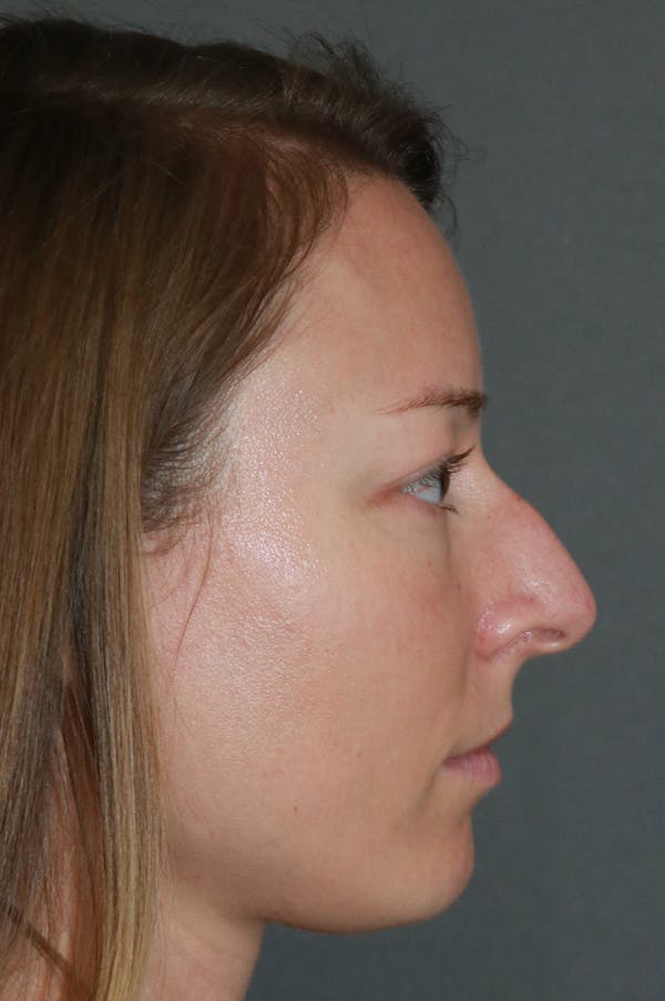 Aesthetic Rhinoplasty Before & After Gallery - Patient 53229901 - Image 7