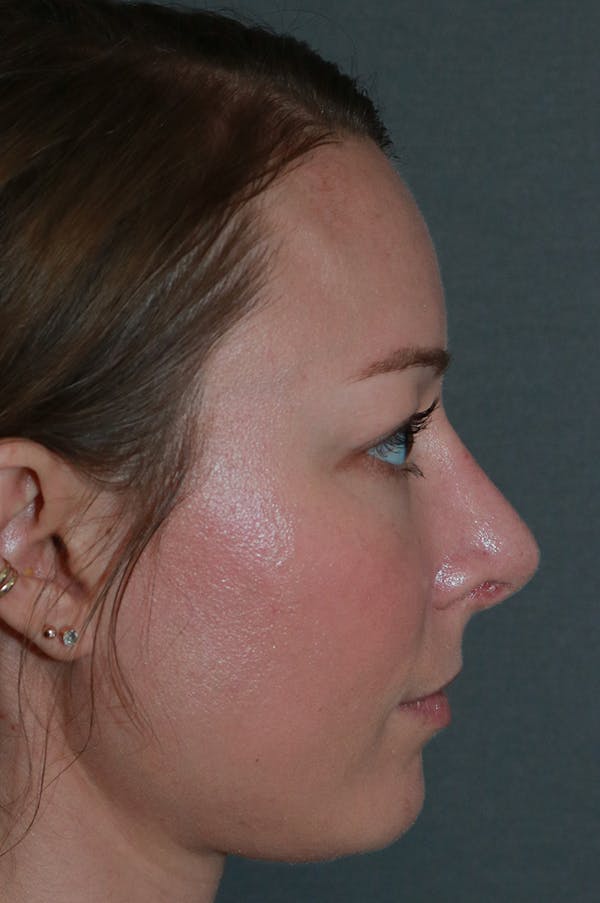 Aesthetic Rhinoplasty Before & After Gallery - Patient 53229901 - Image 8