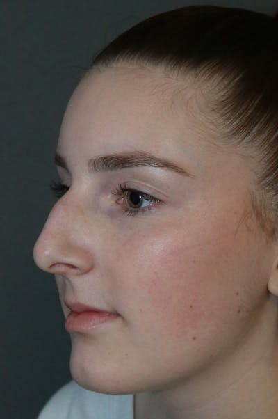 Aesthetic Rhinoplasty Before & After Gallery - Patient 53229902 - Image 1