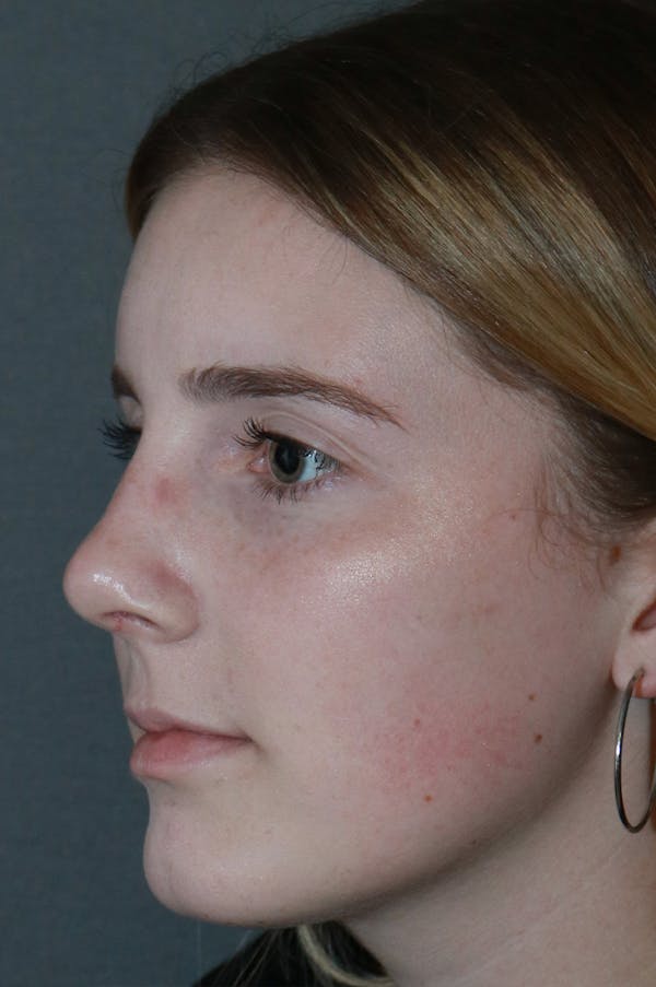 Aesthetic Rhinoplasty Before & After Gallery - Patient 53229902 - Image 2