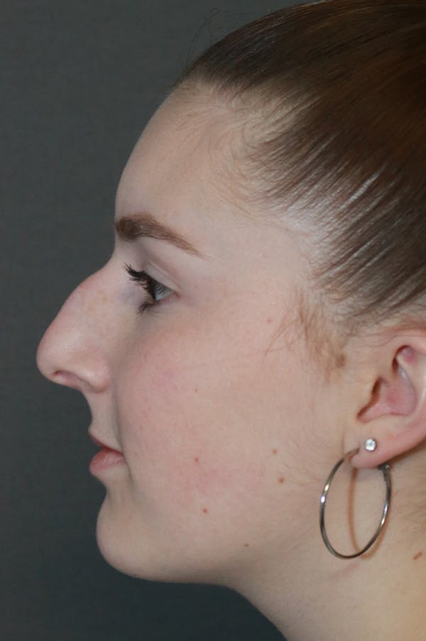 Aesthetic Rhinoplasty Before & After Gallery - Patient 53229902 - Image 3