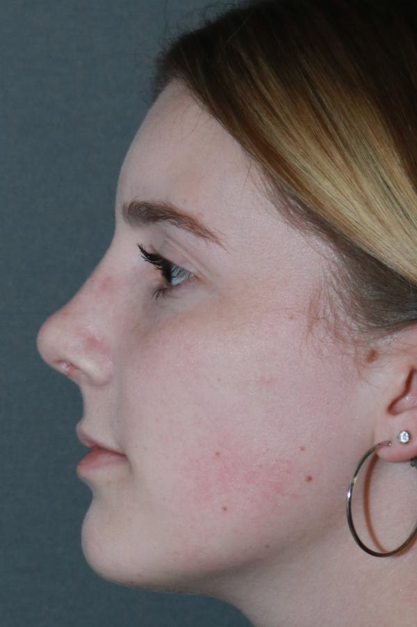 Aesthetic Rhinoplasty Before & After Gallery - Patient 53229902 - Image 4