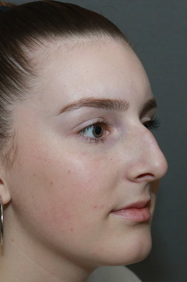 Aesthetic Rhinoplasty Before & After Gallery - Patient 53229902 - Image 5