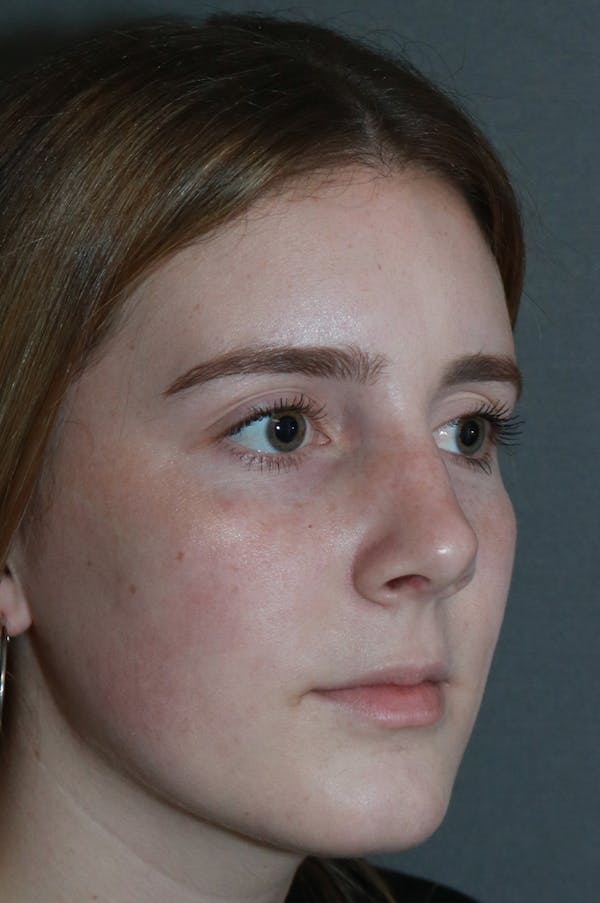 Aesthetic Rhinoplasty Before & After Gallery - Patient 53229902 - Image 6