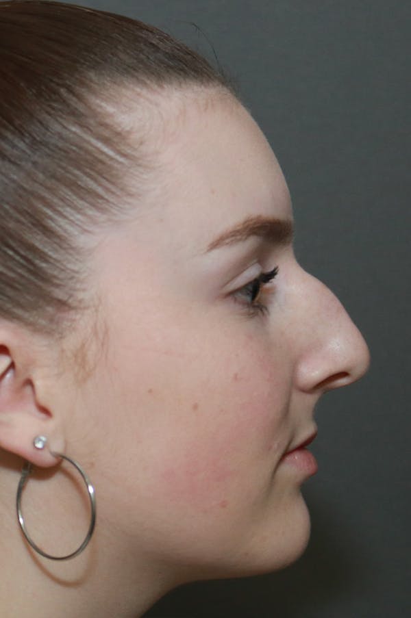 Aesthetic Rhinoplasty Before & After Gallery - Patient 53229902 - Image 7