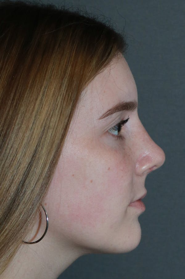 Aesthetic Rhinoplasty Before & After Gallery - Patient 53229902 - Image 8