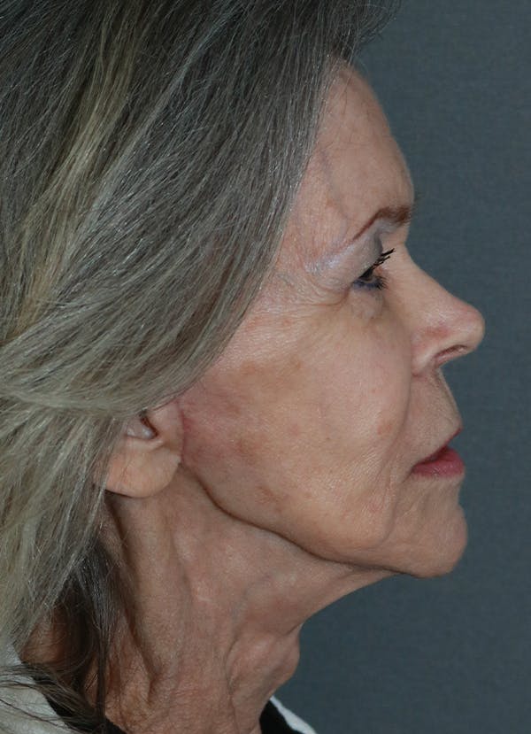 Facelift Before & After Gallery - Patient 53229953 - Image 10