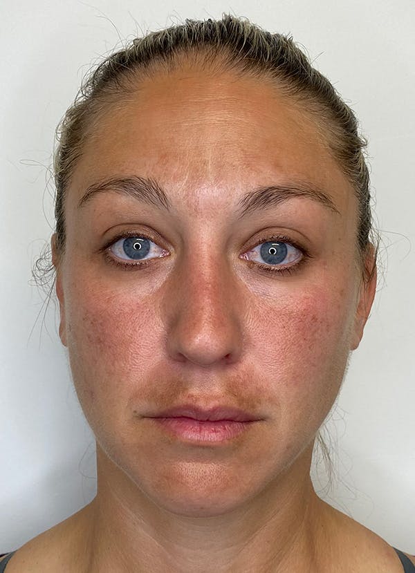Chemical Peels Before & After Gallery - Patient 55281375 - Image 1