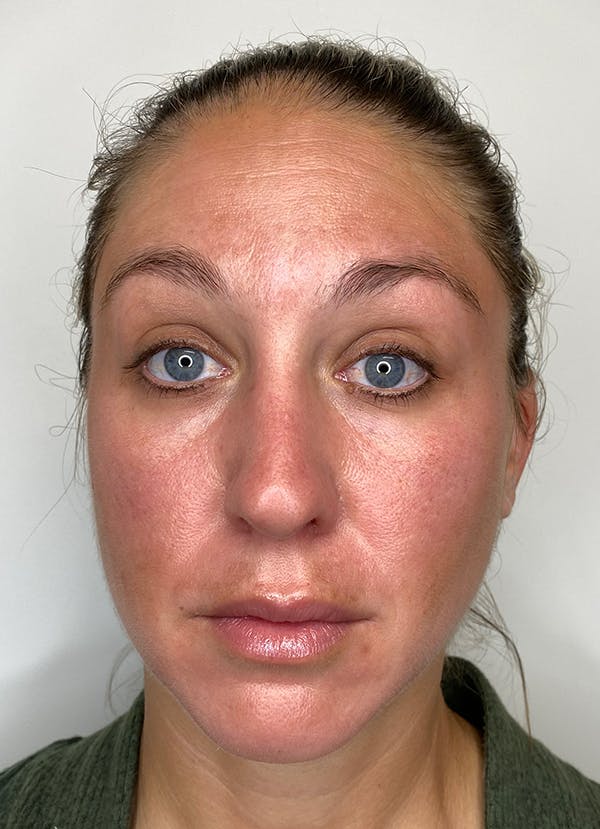 Chemical Peels Before & After Gallery - Patient 55281375 - Image 2