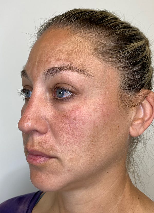 Chemical Peels Before & After Gallery - Patient 55281375 - Image 3