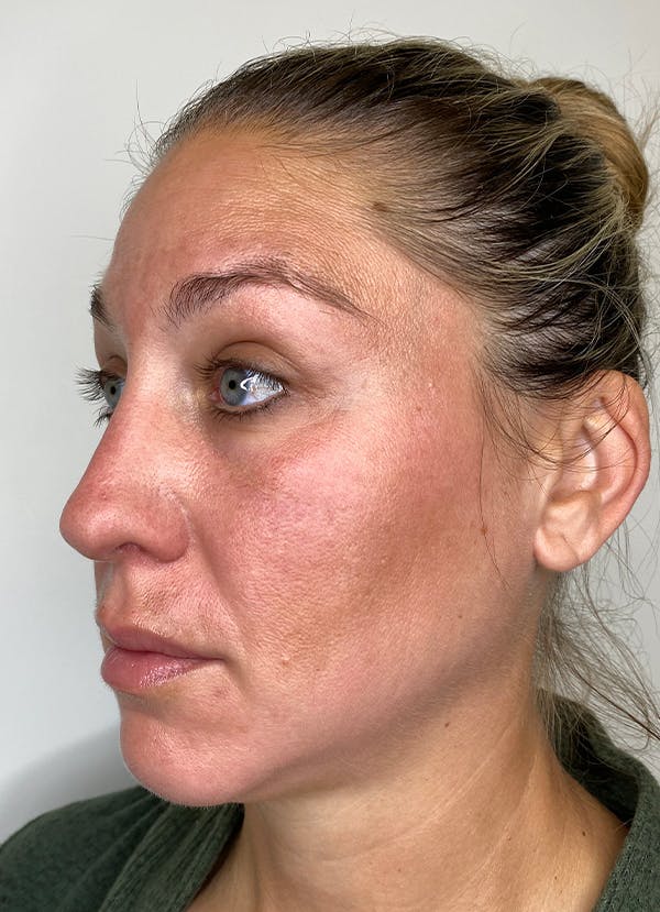 Chemical Peels Before & After Gallery - Patient 55281375 - Image 4