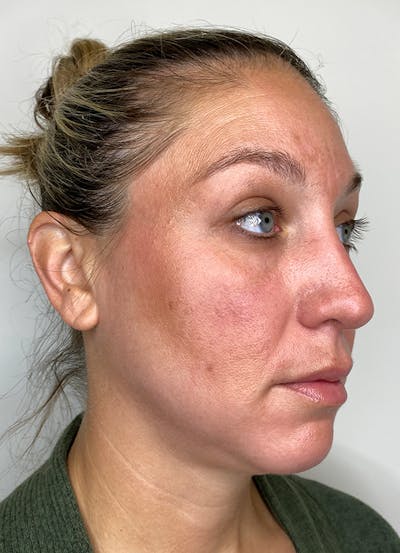 Chemical Peels Before & After Gallery - Patient 55281375 - Image 6