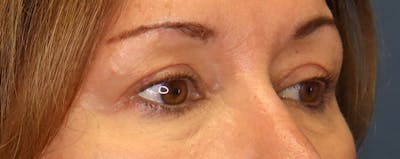Upper Blepharoplasty Before & After Gallery - Patient 57584088 - Image 2