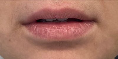 Lip Filler Before & After Gallery - Patient 61325632 - Image 1