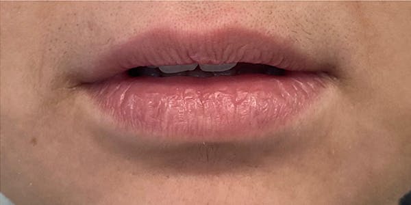 Lip Filler Before & After Gallery - Patient 61325632 - Image 1