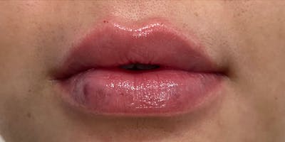 Lip Filler Before & After Gallery - Patient 61325632 - Image 2
