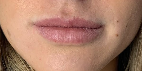 Lip Filler Before & After Gallery - Patient 61325627 - Image 1