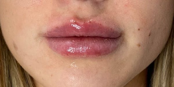 Lip Filler Before & After Gallery - Patient 61325627 - Image 2