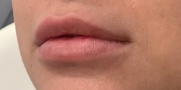 Lip Filler Before & After Gallery - Patient 61325634 - Image 1