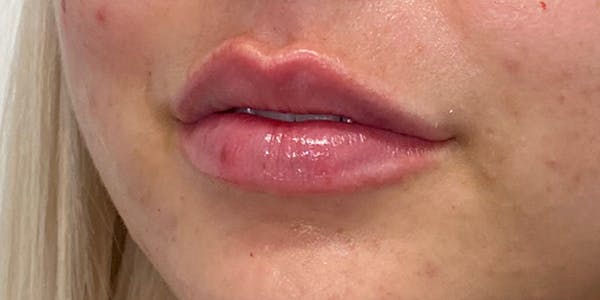 Lip Filler Before & After Gallery - Patient 61325628 - Image 2