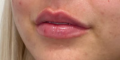 Lip Filler Before & After Gallery - Patient 61325628 - Image 2